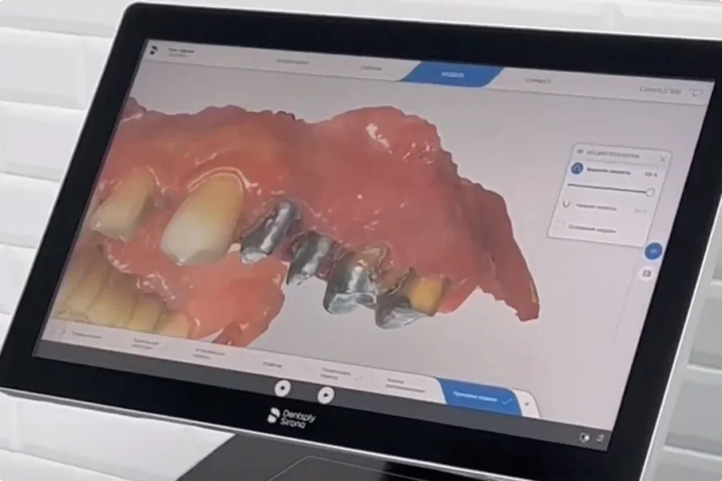Восстановление зубов титановыми вкладками