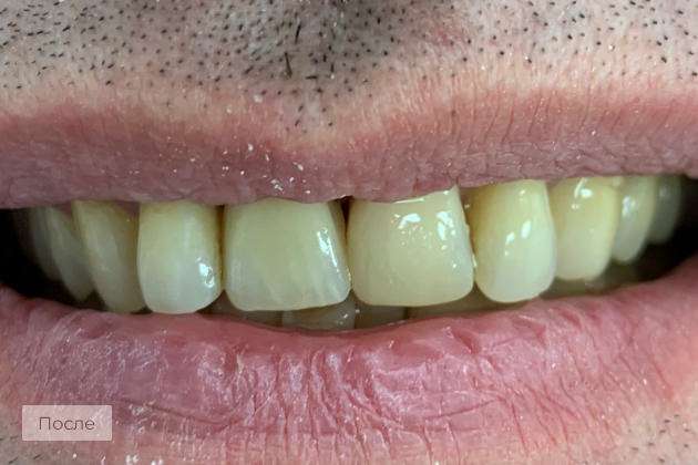 Установка имплантата Штрауманн BLX и коронки