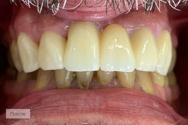 Восстановление фронтальных зубов винирами и мостовидный протез