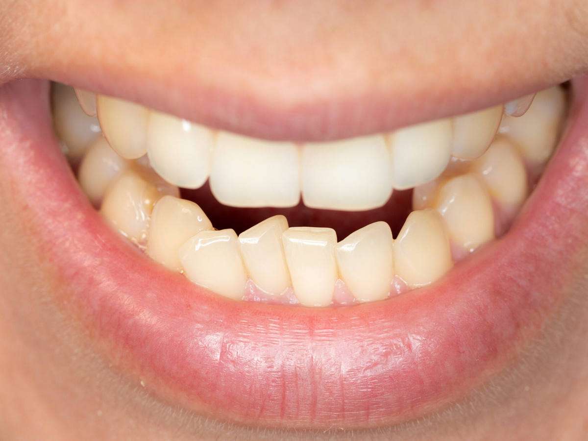 Исправление прикуса: зачем нужна ортодонтия