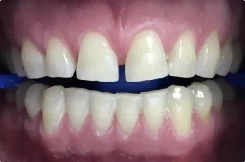 Отбеливание зубов системой ZOOM4