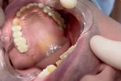 3_titan_vremennye_koronki